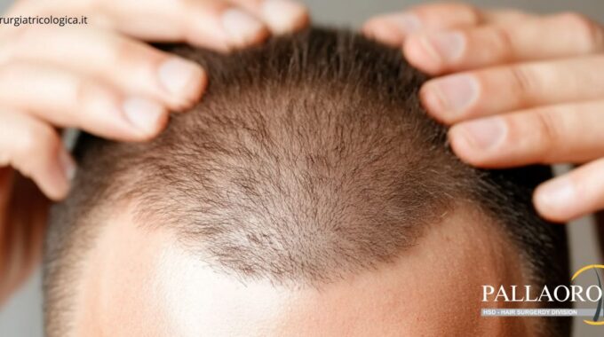 Catagen: Cos’è e perché è importante conoscerlo nel trapianto di capelli