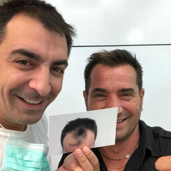 dott alex milosevic pallaoro 05 trapianto capelli