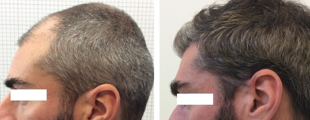 Trapianto Capelli Monselice Tecnica Micro Fue E La Soluzione Alla Calvizie
