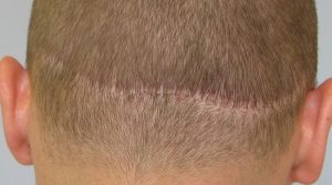 Cicatrice residua post trapianto capelli FUT