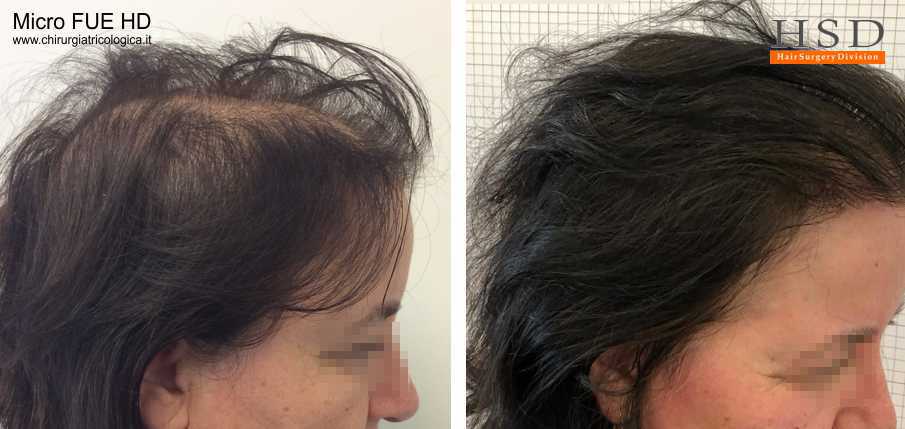 Trapianto capelli donna Micro FUE #49