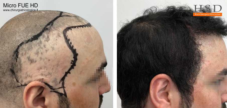 Trapianto capelli Micro FUE #61