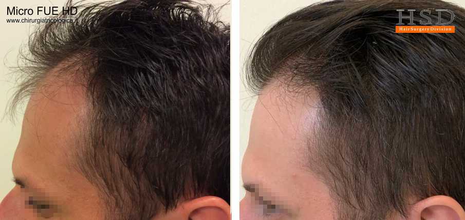 Trapianto capelli Bologna, le tecnica Micro FUE è la decisione ottimale per chi desidera un risultato efficace in una seduta