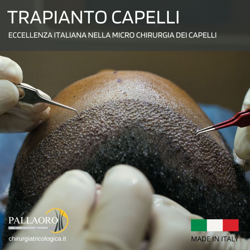 trapianto capelli hsd verona (1)