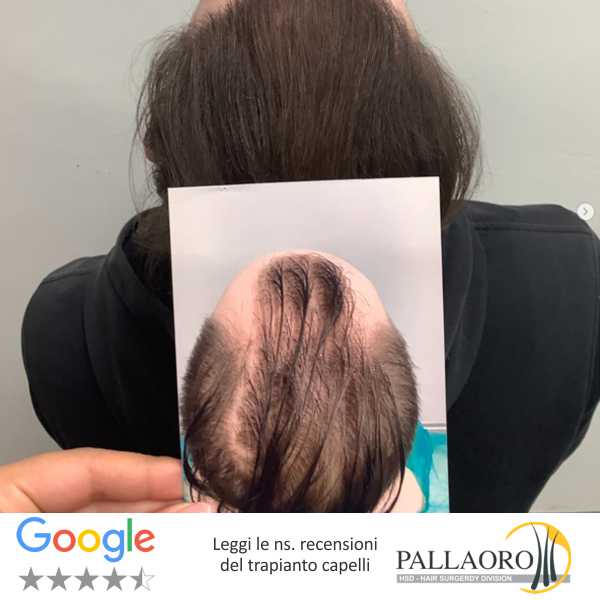 trapianto capelli udine trapianto capelli udine