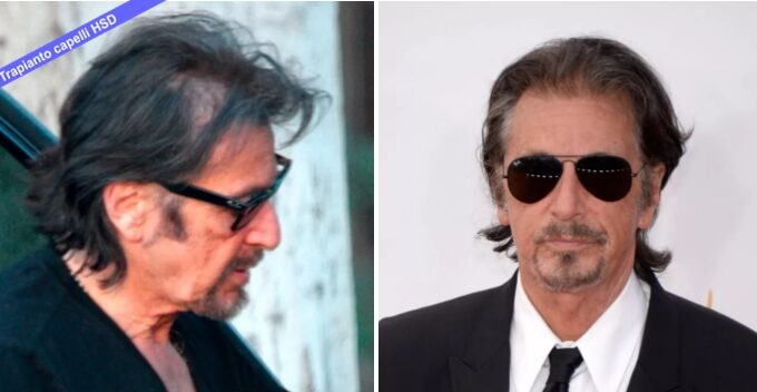 Trapianto capelli VIP Al Pacino