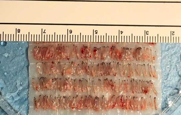 unita follicolari micro fue hd