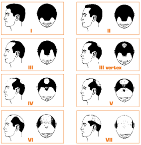 Trapianto capelli femminile